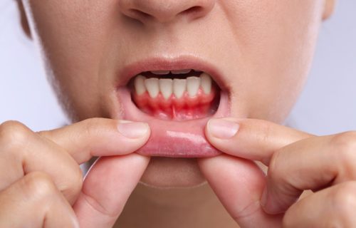 gum-and-systemic-diseases---Untitled-design-(9)c