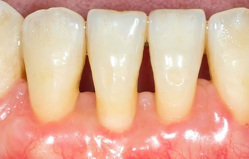 worn-teeth---Attachment-1c