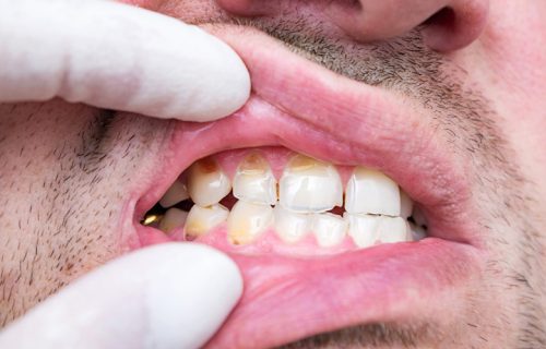 worn-teeth---Untitled-design-(7)c